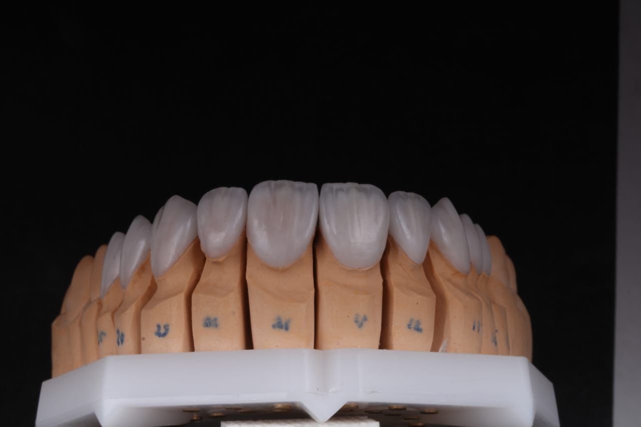 Implant restorations