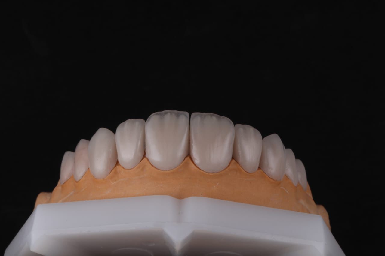 Veneers