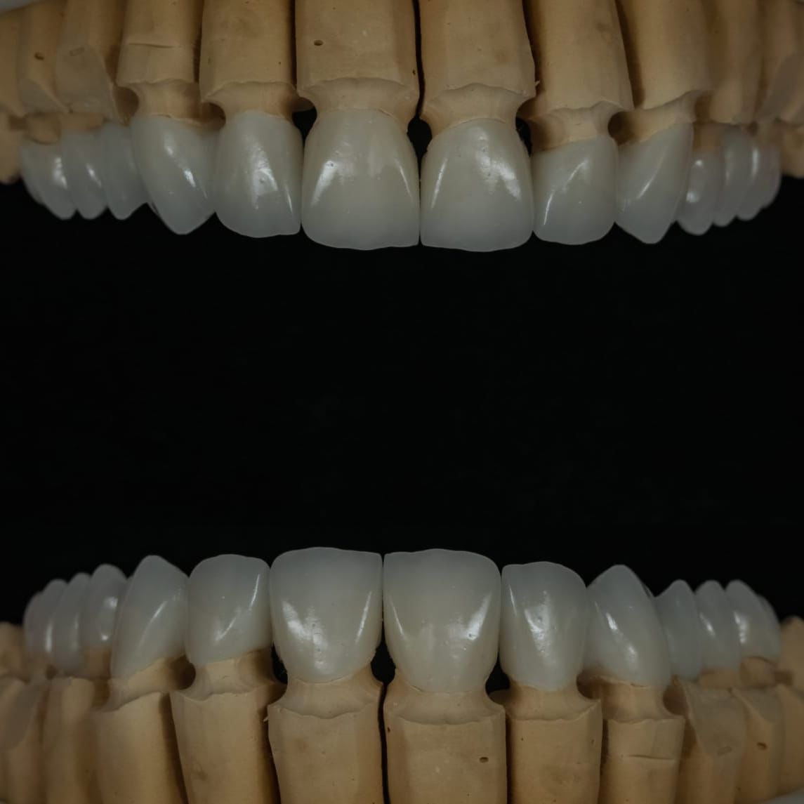 Anterior veneers