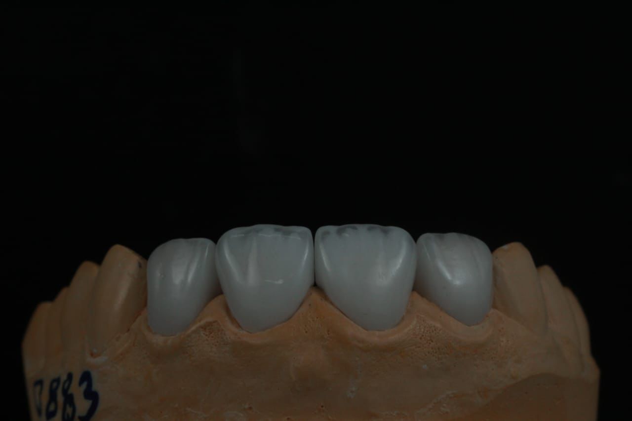 Layered ceramic veneers