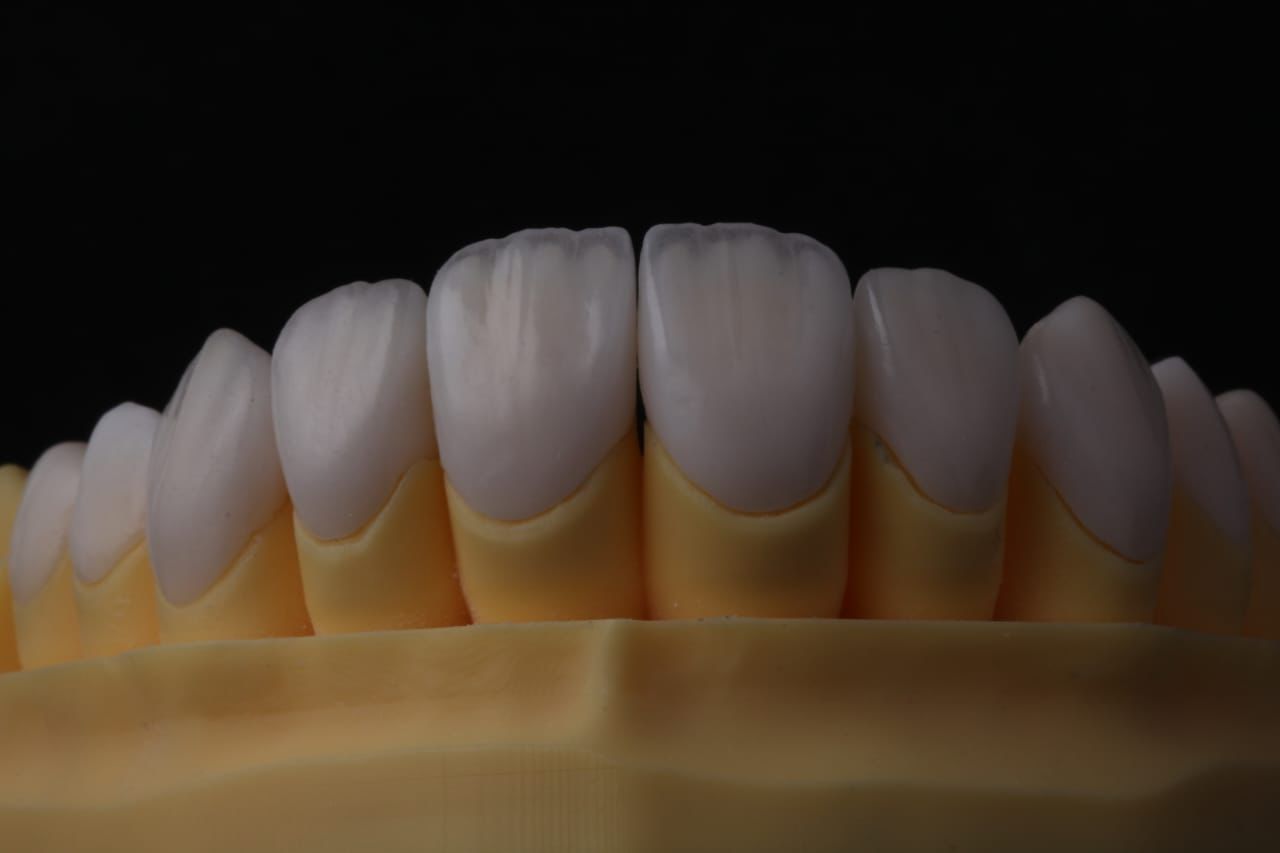 Full anterior veneer case